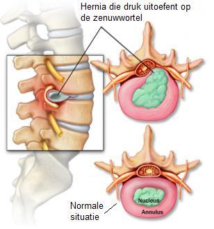 Inleiding Deze brochure biedt u de nodige informatie over de heelkundige behandeling van een lumbale hernia via microdiscectomie.