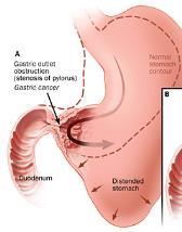 Gastric outlet/maagstase Volheidsgevoel Braken van halfverteerd voedsel Koffiegruis braken Traag werkende maag Verstopping