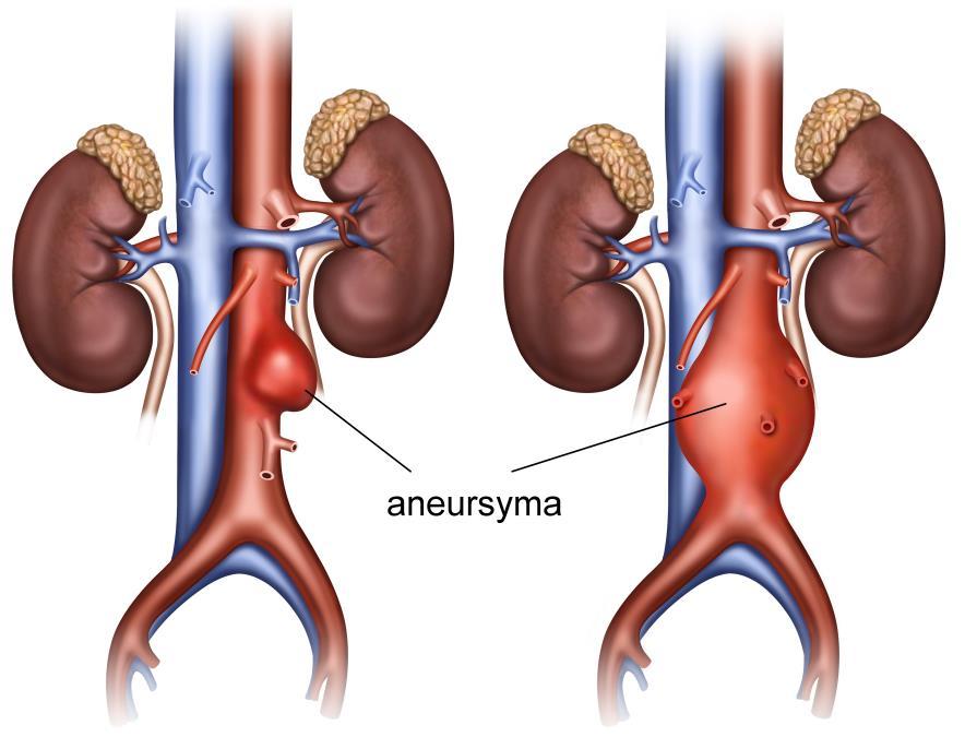 Afbeelding 2: buikslagader is verwijd. Risico s bij een verwijding van de grote buikslagader Een verwijding van de grote buikslagader kan lang bestaan zonder dat u daar iets van merkt.