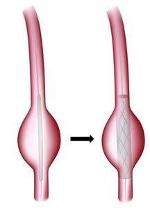 Afbeelding 3: Links de vaatprothese in opgevouwen toestand, rechts is de prothese uitgevouwen. Na de operatie Na de endovasculaire procedure gaat u naar de uitslaapkamer.