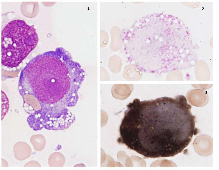 Bespreking Bloeduitstrijkje Aanwezigheid van zowel RBC als blasten. De blasten zijn middelgroot tot groot en vertonen een ruim basofiel cytoplasma (nr 39), dat vaak vacuolen bevat.