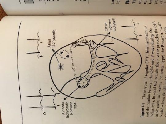 Samenvatting types SVT s Smal complex tachycardie (Inappropriate) Sinustachycardie AF Atriale flutter Atriale