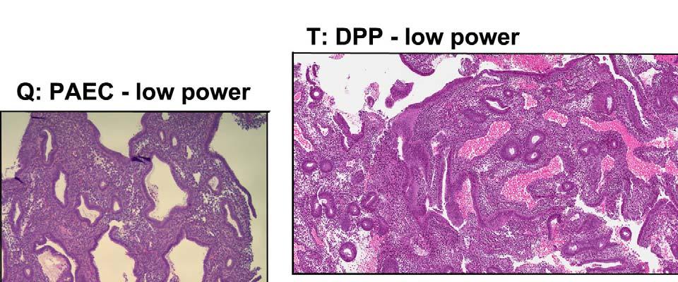 R: S: Q:PAEC high Afbeelding 5 Q-S vergelijkt de veranderingen die we bij PAEC zien met een ongehinderd oestrogeeneffect (disordered proliferative pattern,