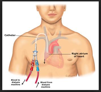 (Afbeelding 2: Getunnelde catheter) Indien de aanleg van een fistel of het plaatsen van een dialysecatheter wordt gepland kan het zijn dat bloedverdunners tijdelijk moeten worden onderbroken.