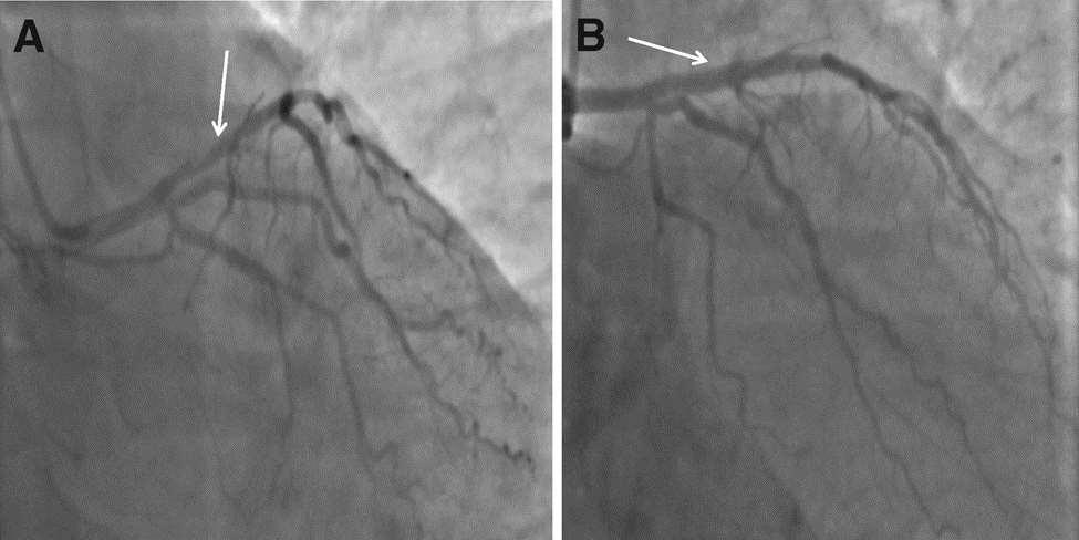 Urgente coronarografie: 90% stenose