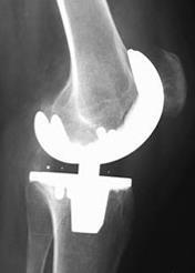 Fig.3: röntgenfoto s na implantatie totale knieprothese Operatie De operatie wordt verricht onder bloedleegte. Hierdoor kan het bovenbeen na de operatie pijnlijk aanvoelen.