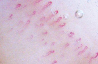 Capillaroscopie is onderzoek van de capillairen (kleine bloedvaten) van de huid bij de nagel.