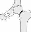 2. Breuken door de verdikkingen van de heupkop (pertrochantere fracturen): deze breuk bestaat vaak uit meerdere delen en is hierdoor minder stabiel en stevig. 3.