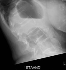 Osteoporose Evidence Conservatieve behandeling: Exercise for improving outcomes after osteoporotic vertebral fracture.