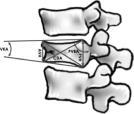 AVH/PVH = vertebral Vermoeden height ratio op posterieur letsel >30 graden kyfose