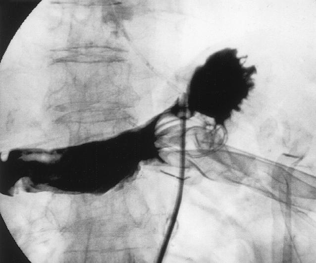 maag gevuld met contrastvloeistof neussonde katheterballon met contrastuitsparing figuur 2. Percutane radiologische gastrostomie bij een 60-jarige man met een orofarynxcarcinoom.