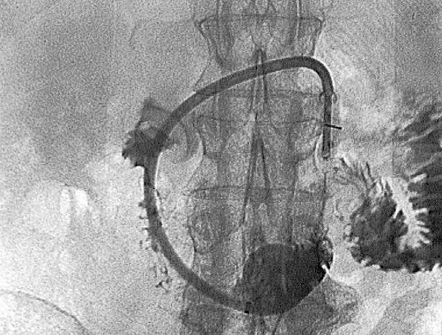 katheter in de maag duodenum figuur 3. Percutane radiologische transgastrische jejunostomie bij een 77-jarige man met dysfagie na een beroerte.