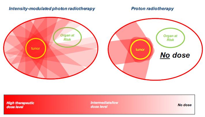 Concept protontherapie Betere distributie van