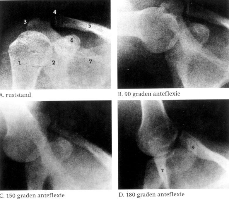 Als gevolg van deze gecombineerde rotatie van de scapula en de clavicula projecteert de processus coracoïdeus zich op de geroteerde clavicula (fig 26 d).