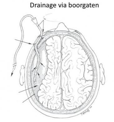 1. Chronisch subduraal hematoom Definitie Dit is een langzaam ontstane bloeduitstorting gelegen tussen de hersenvliezen en de hersenen.