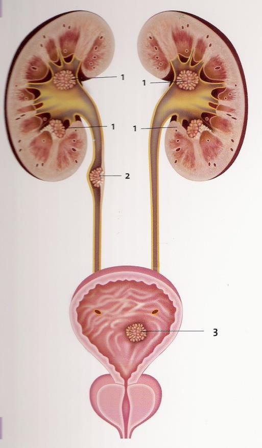 binnenbekleding vormt van de urinewegen, dus ook van de blaas. Een urotheelcelcarcinoom kan ook voorkomen in het nierbekken, de urineleiders of plasbuis (zie afbeelding 3). Afbeelding 3 1.