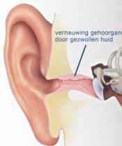 Gehoorgangontsteking Het is dan warm en er wordt meer gezwommen, waardoor er water in de gehoorgang komt.