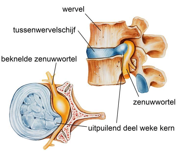 Inleiding Uw behandelend arts heeft met u besproken dat u in aanmerking komt voor Targeted Disc Decompressie (TDD). In deze folder leest u meer over deze behandeling.