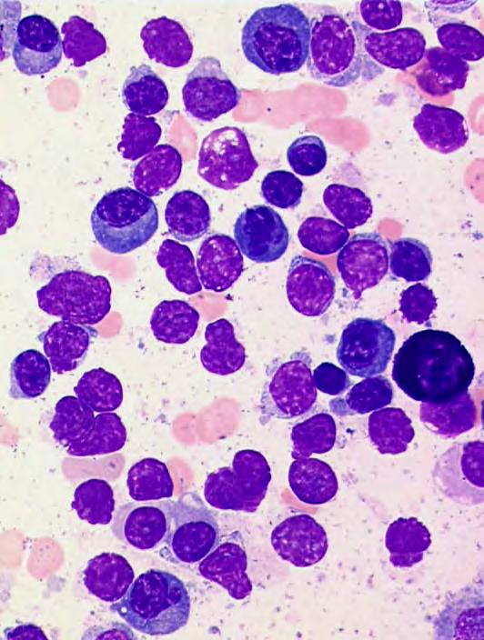 lymfoplasmacytaire cellen, plasma