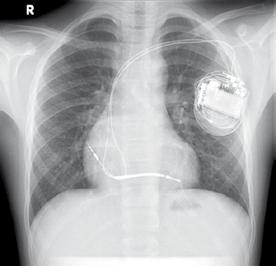 Als de dokter klaar is met de implantatie, legt een technicus een computermuis (zie pagina 7) op de plaats waar de ICD zich bevindt.