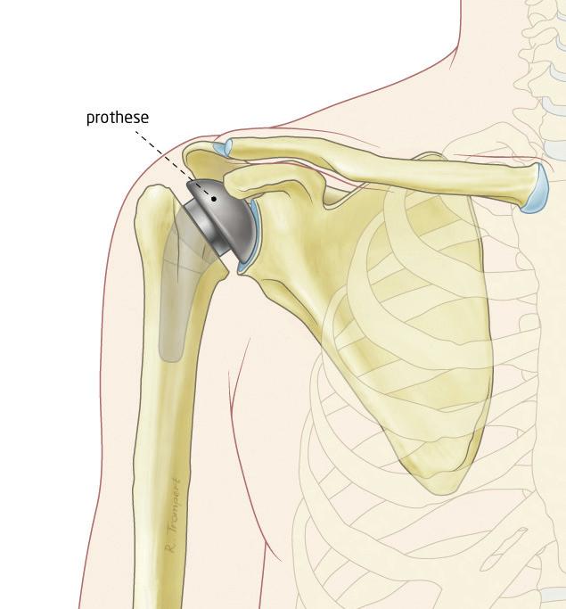 Operatieve behandeling Wanneer de conservatieve behandeling niet het gewenste effect heeft, kan de orthopedisch chirurg samen met de patiënt besluiten tot een operatie, het plaatsen van een