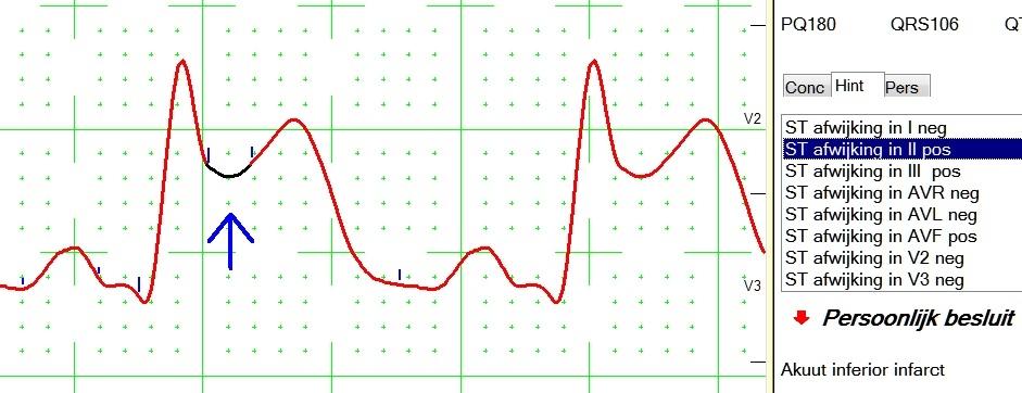 34 Hint tips Onder deze noemer zijn alle afwijkingen te vinden die hoeven gemeld te worden, zonder dat ze daarom pathologisch zijn, zie ook blz 27 Comparator - Ecg interpretatie door