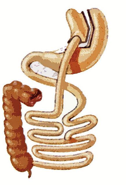 PATIËNTENINFORMATIE 3. Gastric sleeve & gastric bypass operatie De Roux en Y gastric bypass is ontwikkeld door dokter E. Mason en is gericht op een verminderde voedsel in- en opname.
