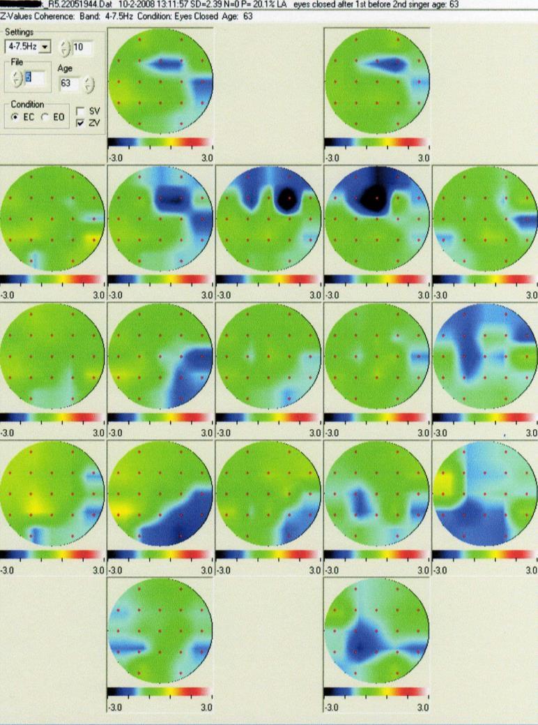 Figuur 8: Z- scores van coherentie patronen van de theta frequenties met gesloten ogen na het zingen De metingen tonen aan dat de algehele coherentiepatronen in de hersenen zijn versterkt tijdens en