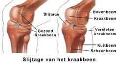 Behandeling van knieartrose Wanneer er sprake is van knieartrose (gevorderde slijtage), is het nodig dat u eerst uw leefgewoonten aanpast zodat u de aangedane knie of beide aangedane knieën minder