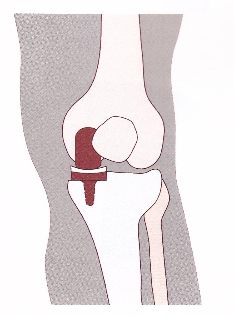 1.6 Operatiemogelijkheden bij een knieprothese 1. Totale knieoperatie Hierbij worden de uiteinden van het dijbeen en van het scheenbeen voorzien van een nieuwe oppervlakte.