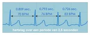 Hart Ritme Variabiliteit is een maat van de beat-to-beat veranderingen in de hartslag. Het diagram toont drie hartslagen welke zijn opgenomen op een elektrocardiogram (ECG).