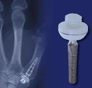 Daardoor stelden ze dat de Avanta prothese geen adequate chirurgische optie is voor de behandeling van CMC artrose van de duim. De overige twee studies [Pendse et al.