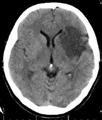 Een CVA of een TIA. Wat is dat precies en hoe wordt het behandeld? CVA is de afkorting van Cerebro Vasculair Accident, vrij vertaald betekent dit een ongeluk in een bloedvat in de hersenen.