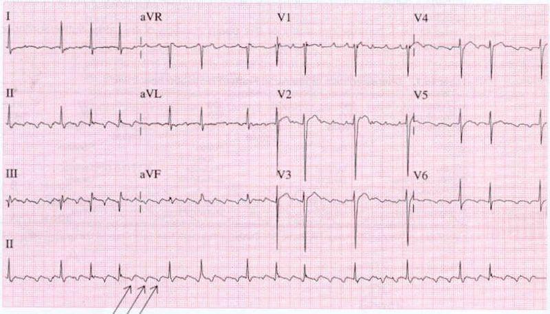 Smal complex tachycardie Sinustachycardie Sinusbradycardie Boezemfibrilleren BoezemfluGer AVNRT