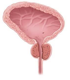 Verwijderen van de prostaat volgens Hryntschak Tijdens uw bezoek aan de polikliniek Urologie heeft de uroloog met u besproken dat u een operatie aan uw prostaat nodig heeft.