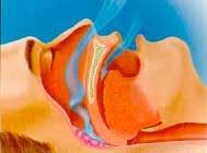 Gedeeltelijke afsluiting van de keelholte veroorzaakt een turbulentie van de luchtstroom, die het weke verhemelte en de andere keelstructuren aan het trillen brengt.