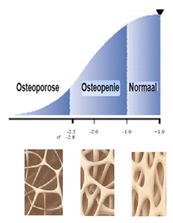 Wat is osteopenie? Osteopenie is een medische term voor een tekort aan bot (osteon = bot, penia = tekort).
