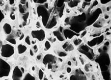 1. Wat is osteoporose en wat zijn de gevolgen? Osteoporose, of botontkalking, is een chronische aandoening van het skelet waarbij de botten steeds brozer worden.