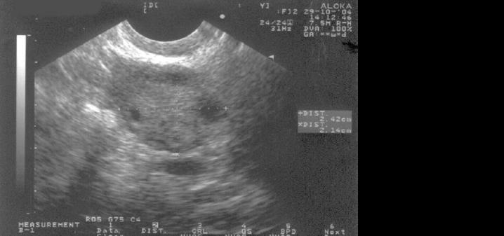 Figuur 1a. Echoscopische afbeelding van een normale eierstok. Onderzoek Om PCOS vast te stellen vindt er meestal bloedonderzoek en echoscopisch onderzoek plaats.