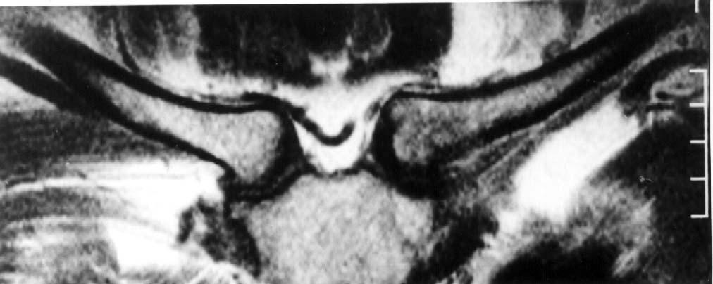 2.6 Het sternoclaviculaire gewricht Het sternoclaviculaire gewricht (fig.