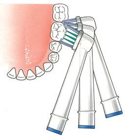Hoe moet ik poetsen met een elektrische tandenborstel? Hieronder volgt een heldere poetsinstructie voor het roterende systeem. De poetstechniek voor de sonische variant wijkt hiervan af.