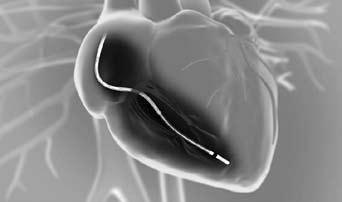 wat hartkloppingen. De technicus meet met behulp van een computer of de draden op de juiste plaats in uw hart liggen en stelt de ICD in. Hierna plaatst de cardioloog de ICD in de ruimte onder uw huid.