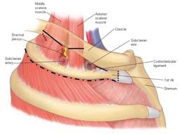 Procedure tijdens de operatie De operatie kan worden uitgevoerd via de oksel (transaxillaire benadering) of via een incisie boven het sleutelbeen (supraclaviculaire benadering).