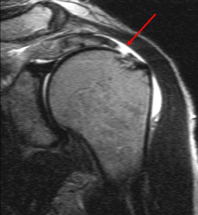 MRI-scan: volledige cuff-scheur Behandelopties Er zijn verschillende behandelingen mogelijk voor een beknelling en of scheur van de rotator cuff spieren.