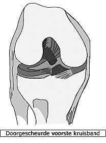 HOE ONTSTAAT EEN SCHEUR VAN DE VOORSTE KRUISBAND?