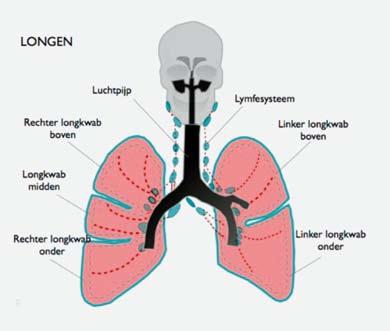 Het merendeel van de carcinoïden groeit in de centrale luchtwegen en kan leiden tot afsluiting van een bronchus (luchtpijp), waardoor veel slijm zich ophoopt en een infectie met kortademigheid