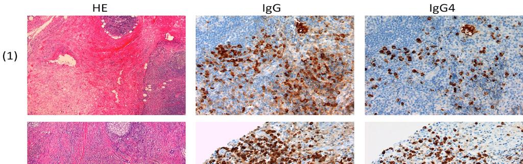 Figure 1: histological (H&E) and immunological images of IgG and IgG4 staining in patients with