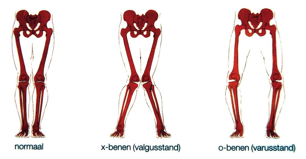normaal x-benen (valgusstand) 0-benen (varusstand) Voorbereiding op de operatie Vóór de opname in het ziekenhuis wordt u, afhankelijk van uw leeftijd en eventuele andere aandoeningen, meestal