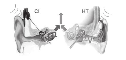 CI in één oor, wie blijft een hoortoestel gebruiken in het andere oor? Door de jaren heen zijn de criteria voor cochleaire implantatie veel ruimer geworden.