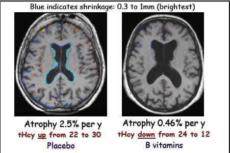 Nutrient interactions cognitive decline NHANES 3706 >60 yrs B12-status Folate N OR